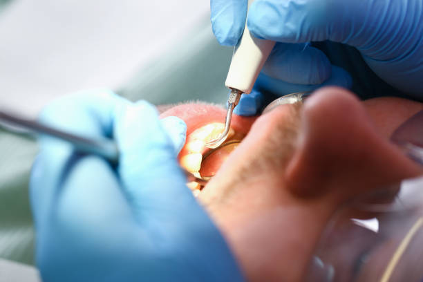 Best Emergency Tooth Extraction in Seymour, IN